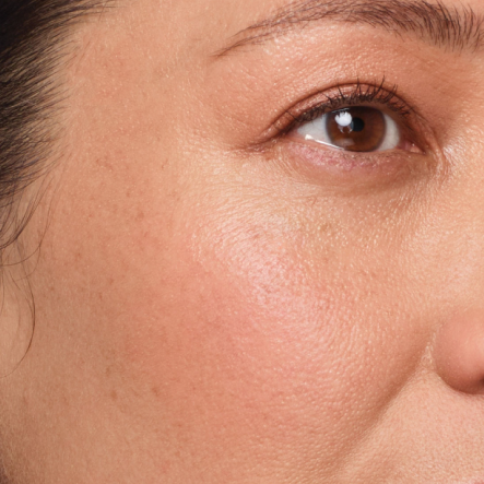 Close up of actual JUVÉDERM® patient treated in the cheeks