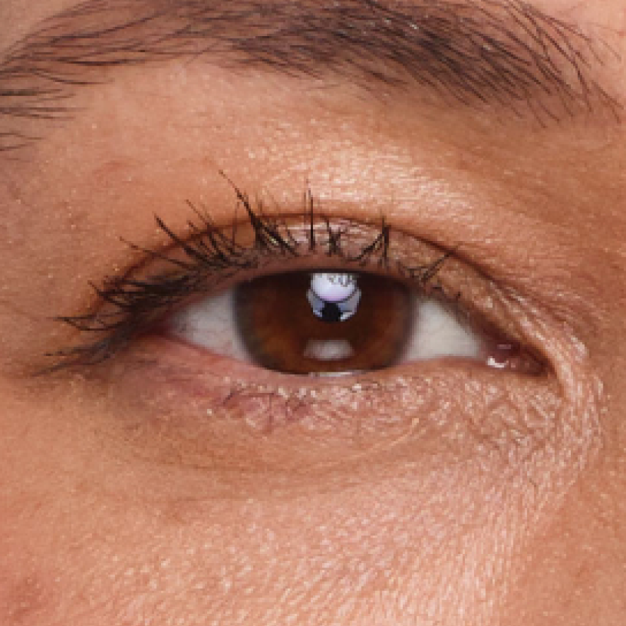 Close up of actual JUVÉDERM® patient treated in the undereyes