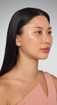 Cheeks - After Juvederm