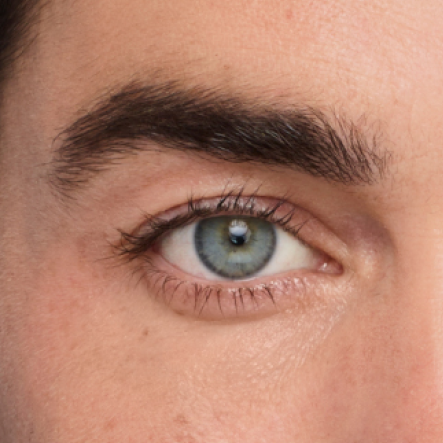 Close up of actual JUVÉDERM® patient treated in the undereye area