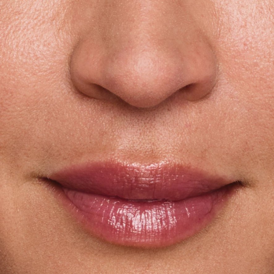 Close up of actual JUVÉDERM® patient treated in the lips