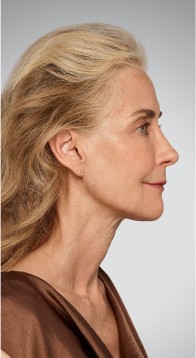 Jawline - After Juvederm