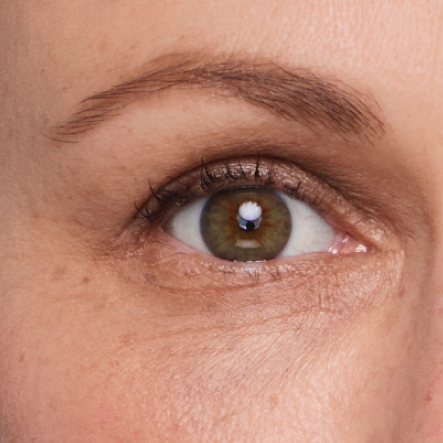 Close up of actual JUVÉDERM® patient treated in the undereye area