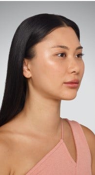 sara - cheeks, undereye, lips & jawline After Juvederm