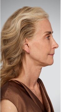 Jawline - Before Juvederm