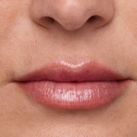 Close up of actual JUVÉDERM® patient treated in the lips