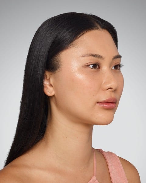 sara - cheeks, undereye, lips & jawline After Juvederm