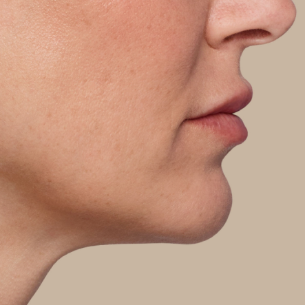 Close up of actual JUVÉDERM® patient treated in the chin