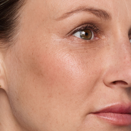 Close up of actual JUVÉDERM® patient treated in the cheeks