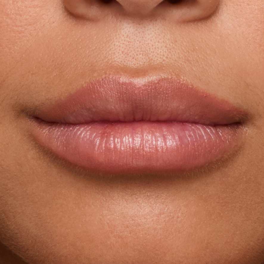 Close up of actual JUVÉDERM® patient treated in the lips