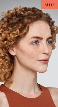 addieson - cheeks, chin, undereye & lips After Juvederm