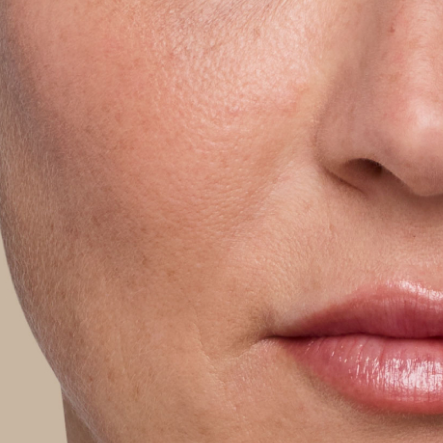 Close up of actual JUVÉDERM® patient treated in the smile lines