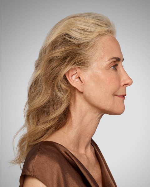 Jawline - After Juvederm